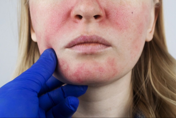 How to Treat Rosacea On the Face?