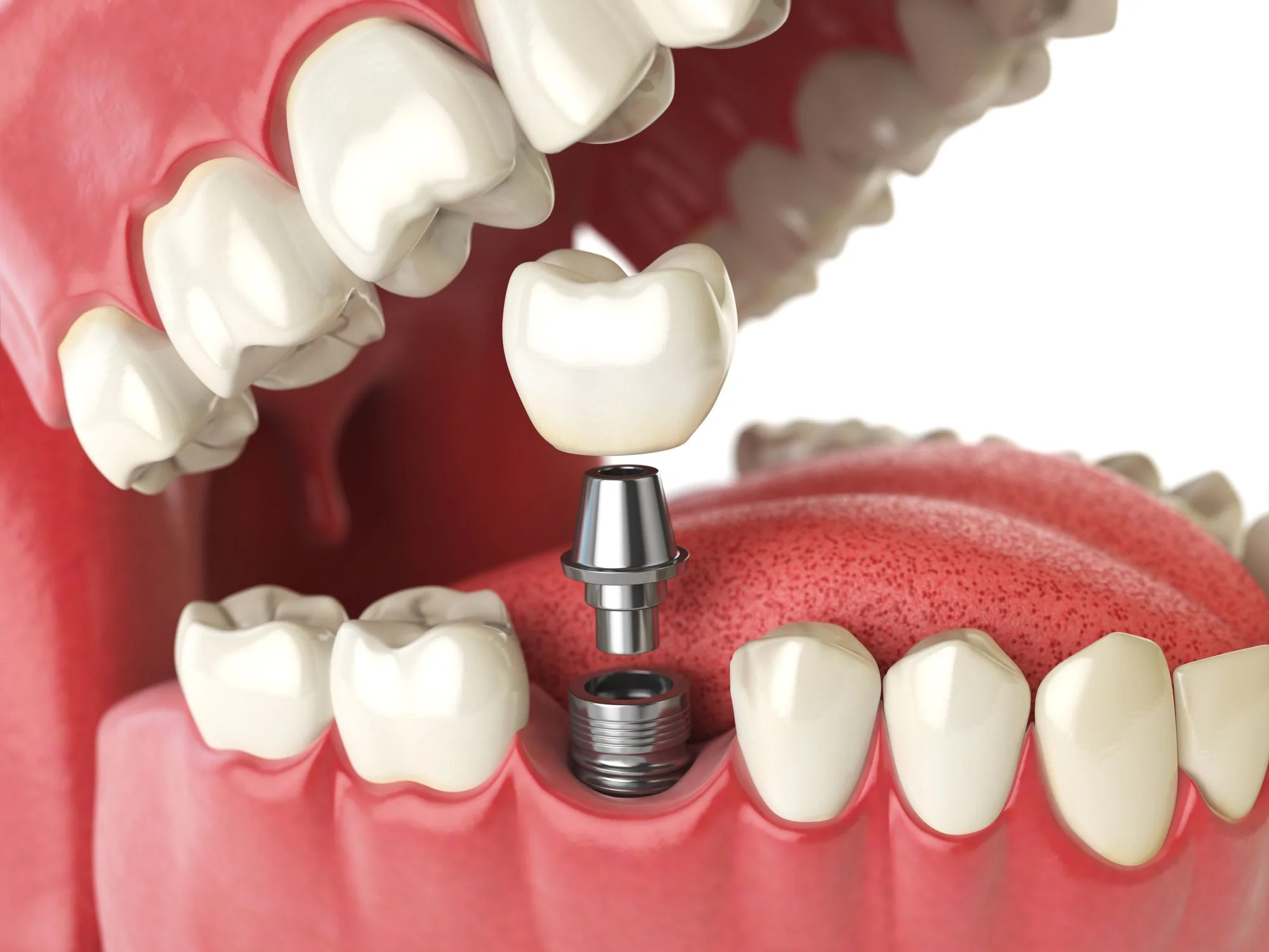 What Are the Key Benefits of Dental Implants?