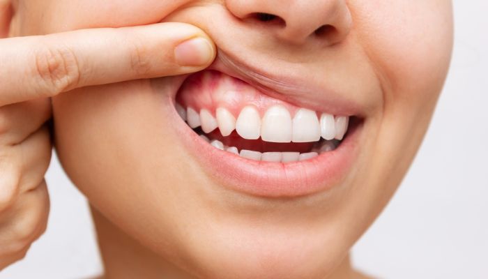 Zinc Citrate and Oral Health: Preventing Gum Disease and Bad Breath