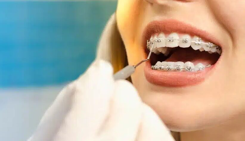 The Critical Role of Retainers in Post-Orthodontic Care