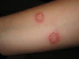 How to Identify and Treat Ringworm